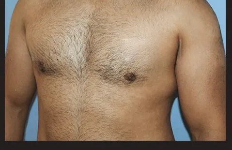 Après : torse aplani — photo réelle du même patient
